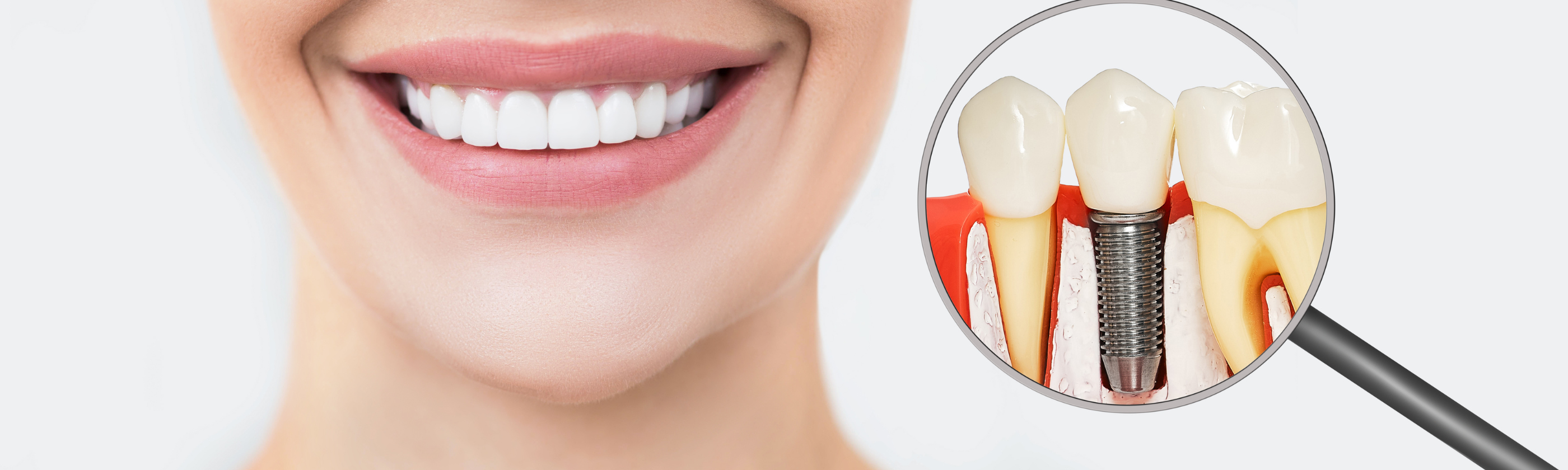 Dental Implants: A Permanent Solution for Missing Teeth